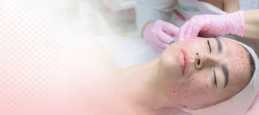 Vampire facial PRP treatment for glowing skin