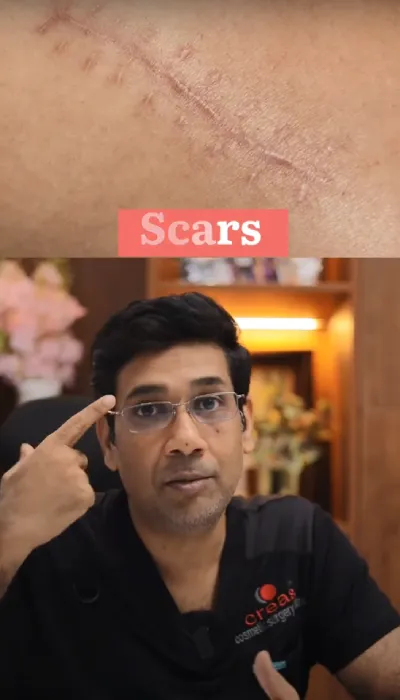 Reduce Appearance of Scars